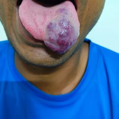 Tongue Hemangioma