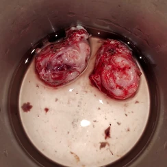 Adenoids and Tonsils